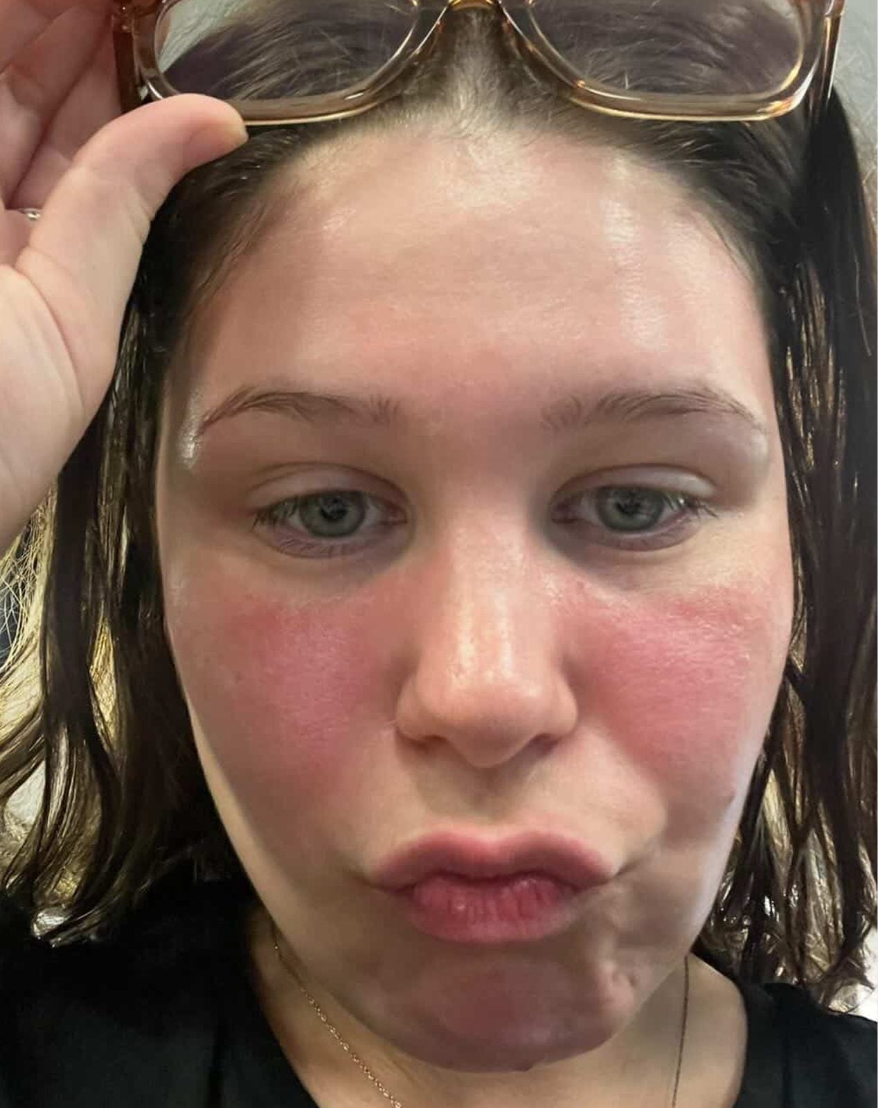Before: selfie with flushed red cheeks